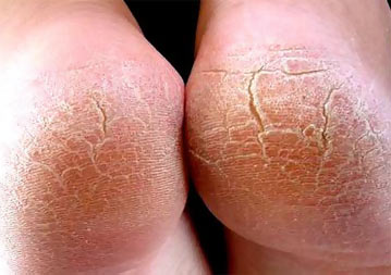 Трещины на пятках Трещины на пятках